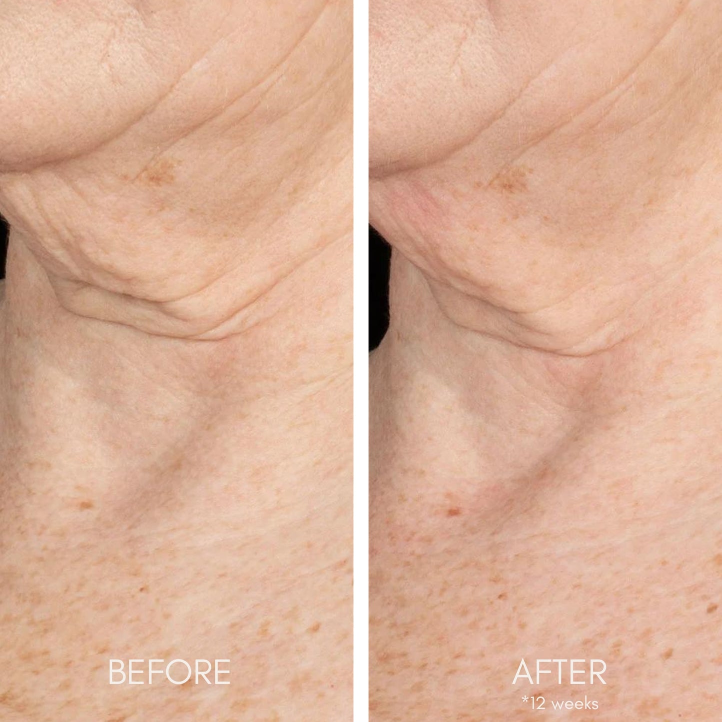 Side-by-side before and after comparison of a person's neck showing visible skin improvement after 12 weeks of treatment. The 'before' side shows deeper wrinkles and uneven texture, while the 'after' side shows smoother, firmer skin.